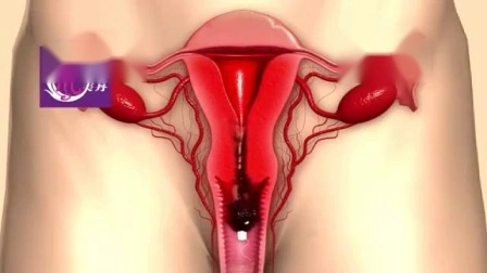 Womb Detox Vaginal Clean Point Tampon Damenhygieneprodukt für Frauen